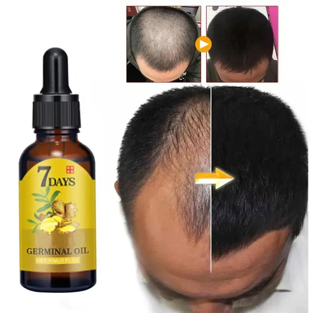 Biotin Hair Growth - Hair Growth Ginger Fast Growing Hair